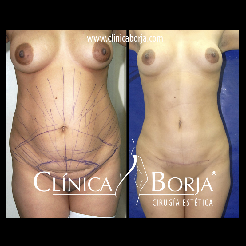 lipo