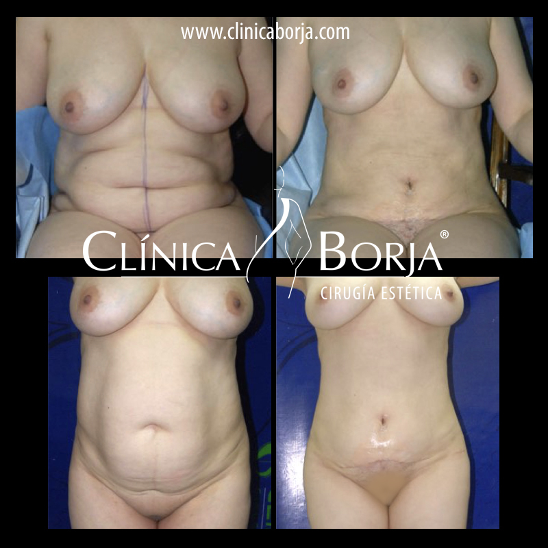 lipo