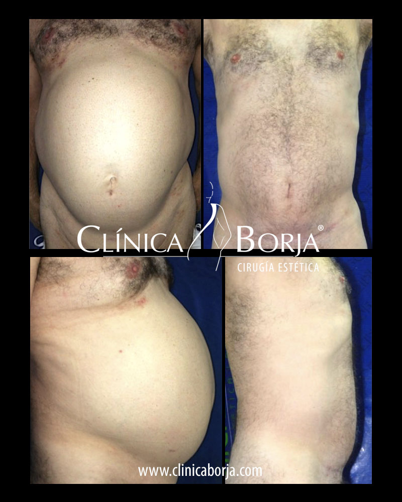 abdomen
